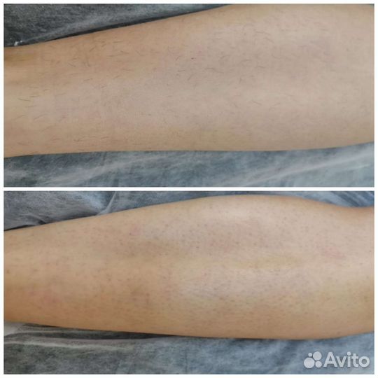 Восковая депиляция