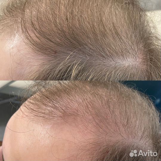 Холодная плазма, омоложение, лечение целлюлита