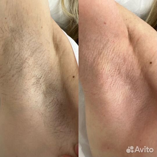 Шугаринг депиляция