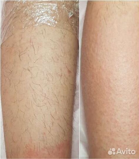 Антицеллюлитный массаж