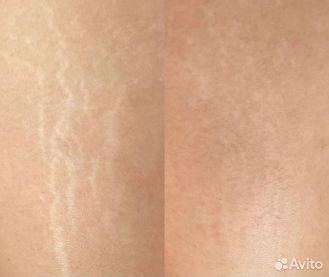 Камуфляж шрамов, растяжек, ареол