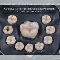Пломбирование зубов, Махачкала