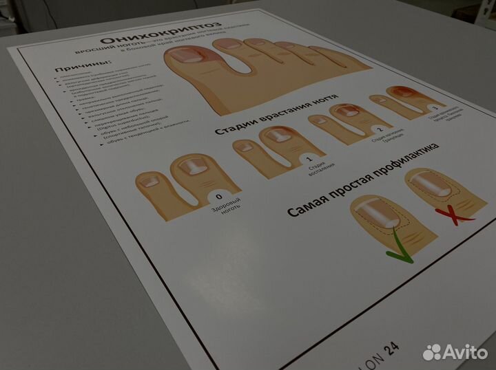 Плакат онихокриптоз