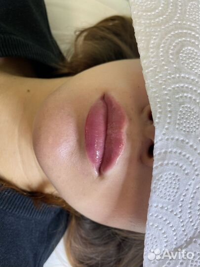 Увеличение губ