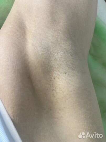 Депиляция воском: глубокое бикини