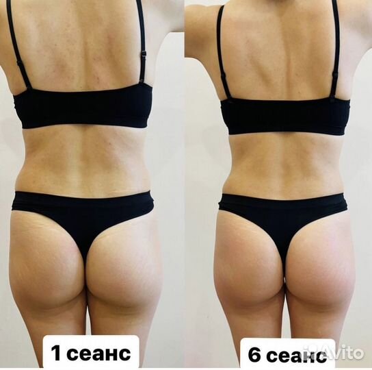 Антицеллюлитный массаж. LPG массаж. Похудение