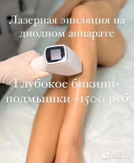Лазерная эпиляция