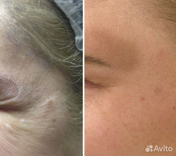 Чистки лица