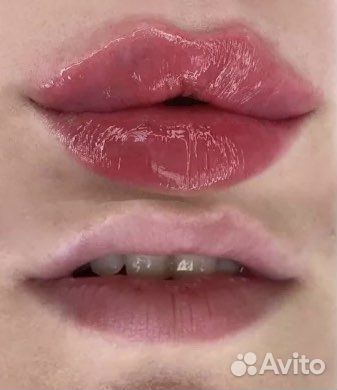 Увеличение губ