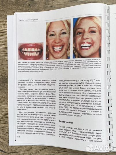 Керамические виниры