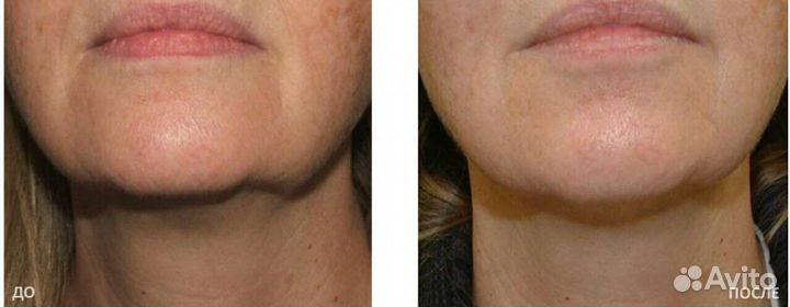 Омоложение без инъекций