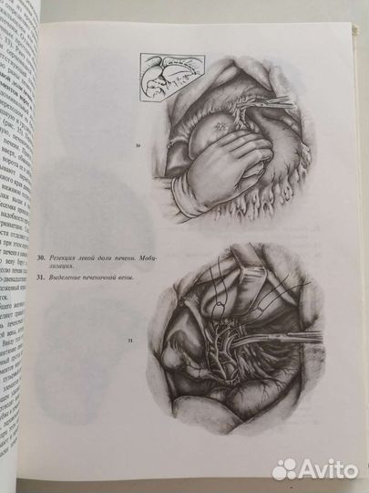 Атлас операций на печени, желчных путях и пр
