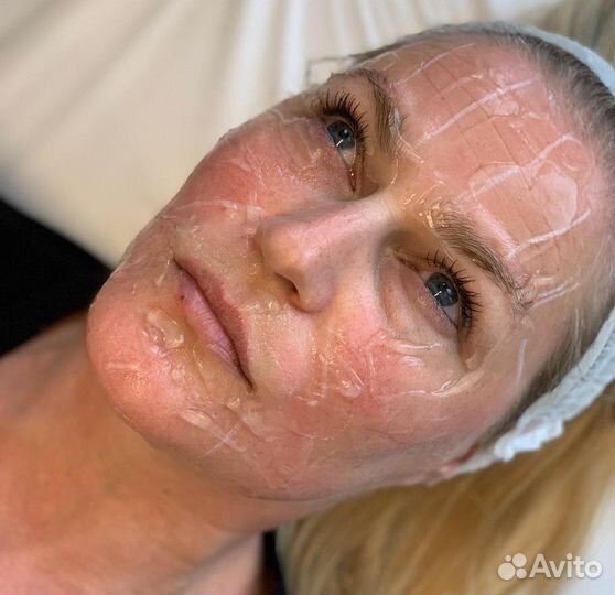 Модель на лифтинг аппаратом Ультраформер 3