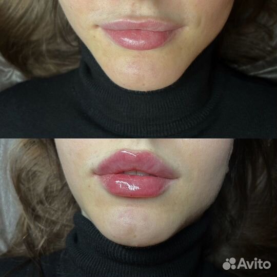 Модель на увеличение губ