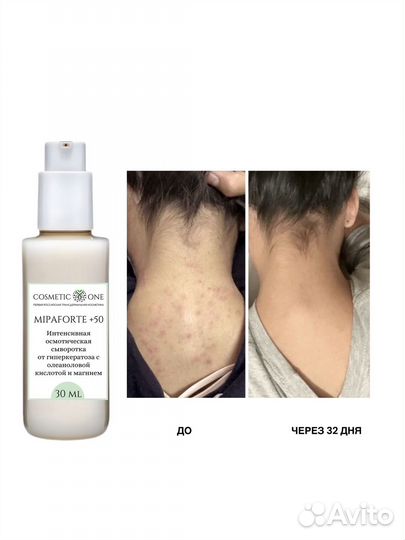 Сыворотка от гиперкератоза