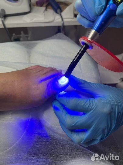 Установка титановой нити