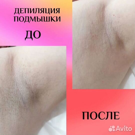 Шугаринг