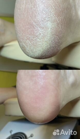 Педикюр, подолог