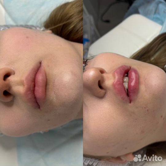 Увеличение губ