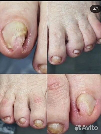 Подолог амур / шипица/грибок/вросший ноготь