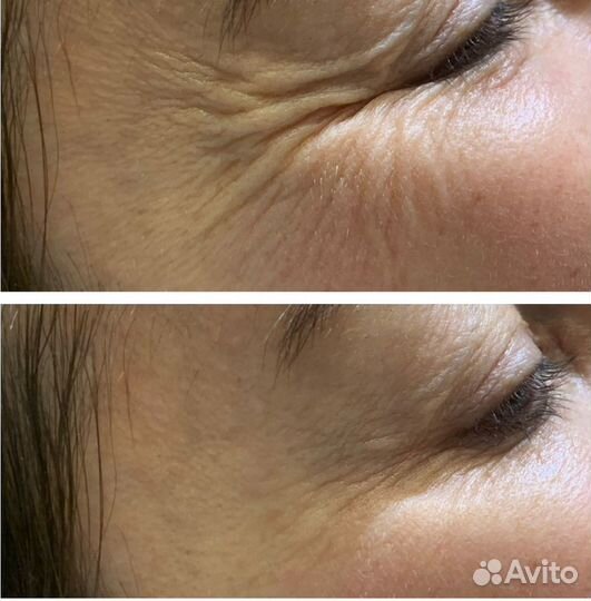 Ботокс для лица