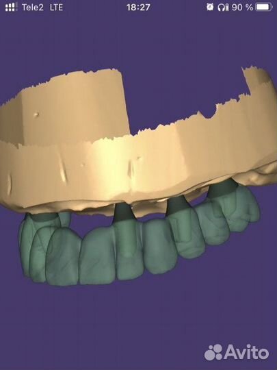 Моделировка в exocad