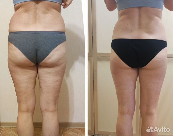 Аппаратная коррекция фигуры