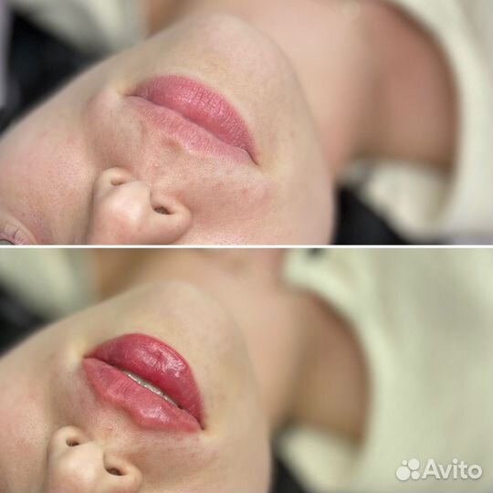 Увеличение губ