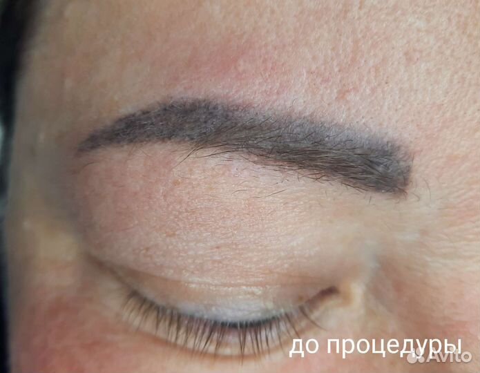 Удаление татуажа ремувером