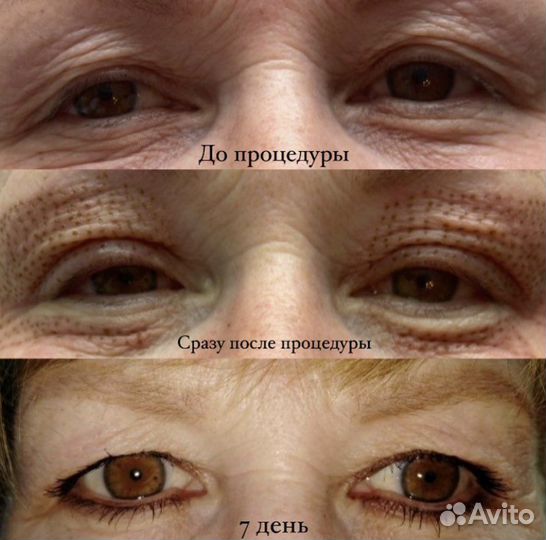 Безоперационная блефаропластика