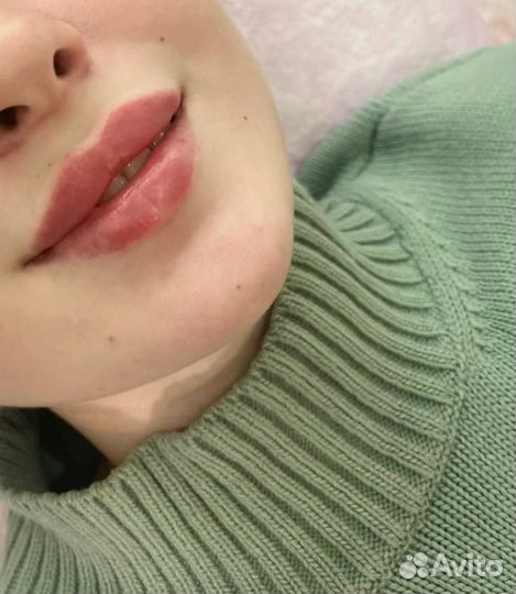 Биоревитализация