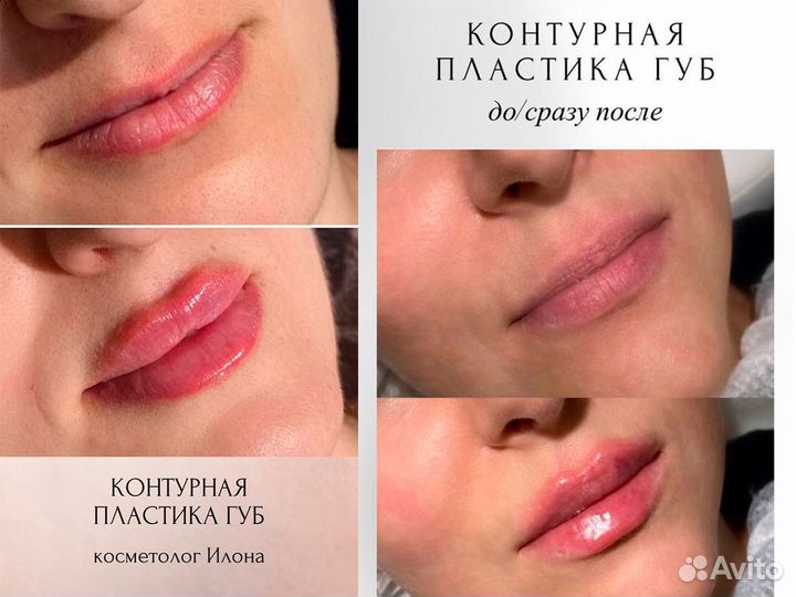 Увеличение губ, пиллинг, био, мезо