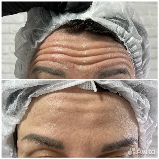 Ботулинотерапия