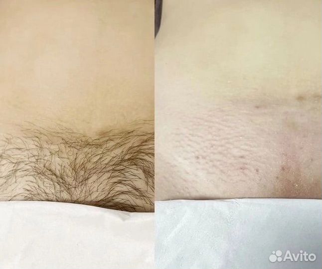 Депиляция