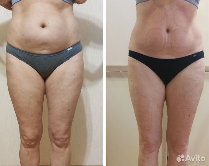 Аппаратная коррекция фигуры