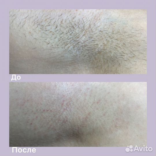 Шугаринг, воск, депиляция