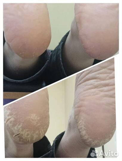Смарт Педикюр. Педикюр