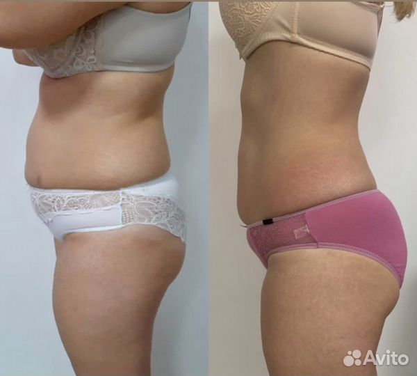 Массаж коррекция фигуры