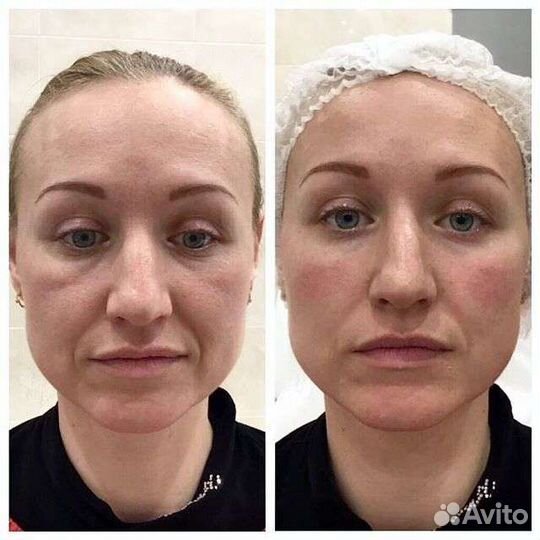 Безоперационная подтяжка лица, РФ лифтинг