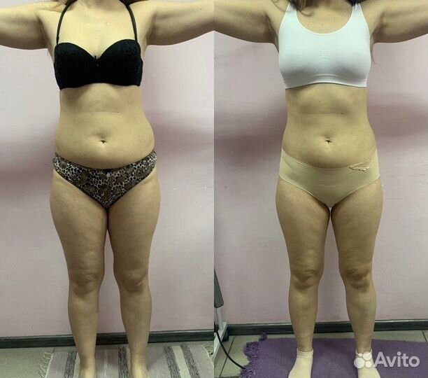 LPG массаж на аппарате B-Flexy