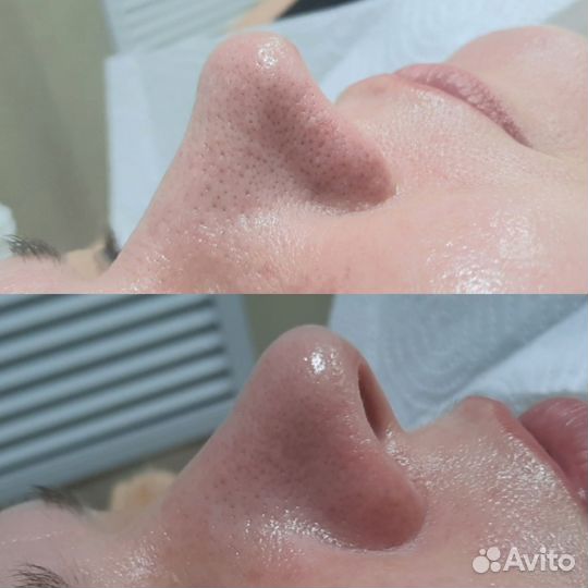 Чистка лица