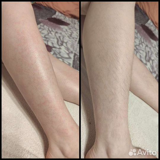 Депиляция женская и мужская