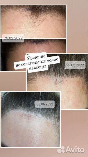 Электроэпиляция
