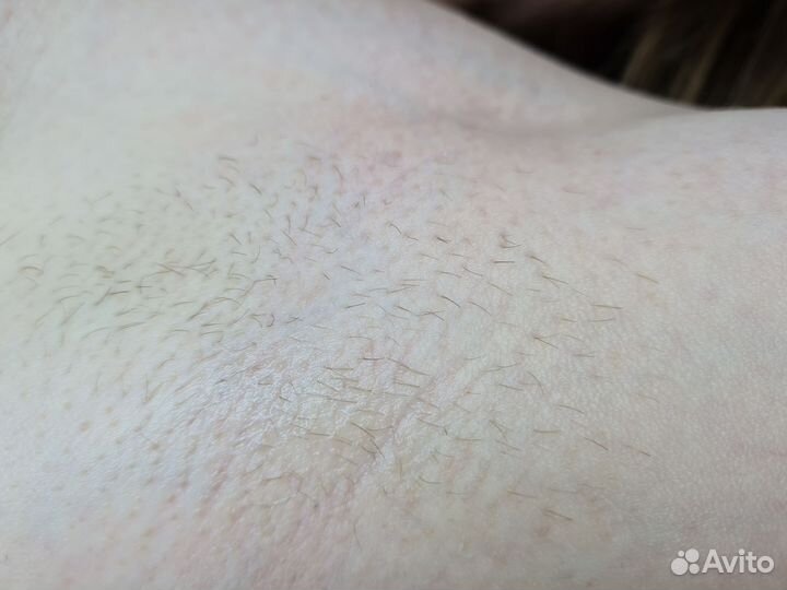 Электроэпиляция