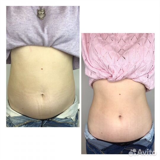 Тейпирование