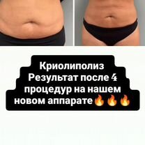 Криолиполиз похудение, Майкоп