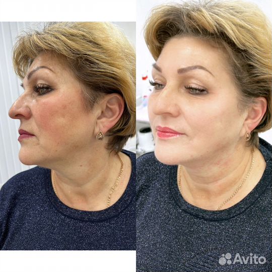 Аппаратная мезотерапия