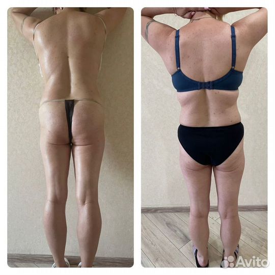 Lpg,EMS,Криолиполиз,Эндосфера,Мадеротерапия