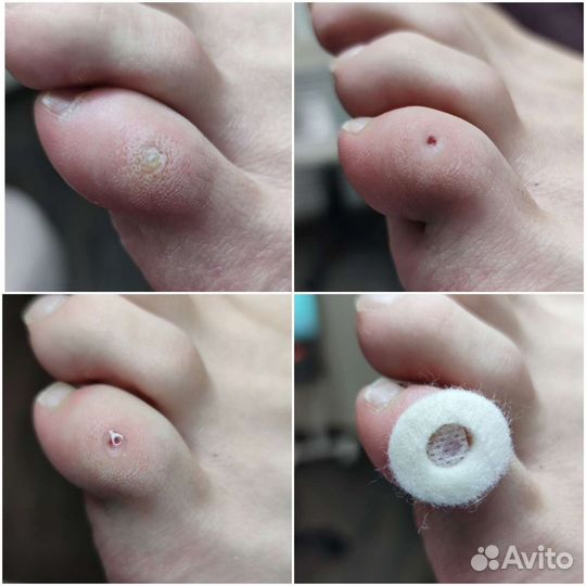 Педикюр Подолог