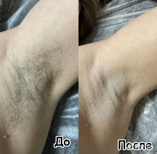 Депиляция: сахар, воск. Закамск